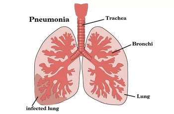пневмония симптомы
